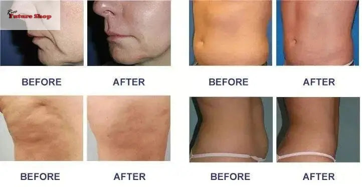 Equipment Skin Tightening Vacuum Slimming - Rios Future Shop