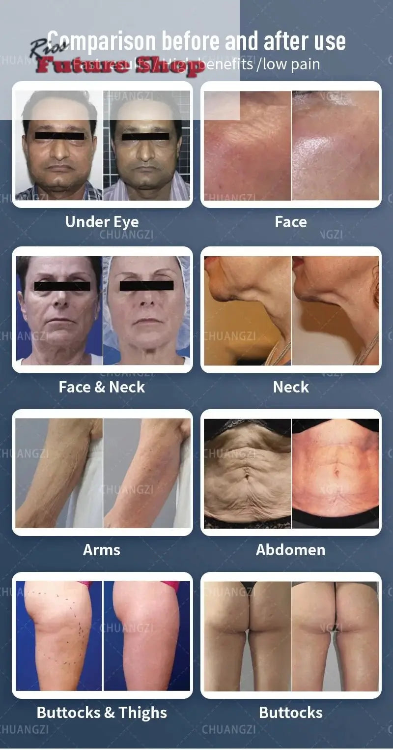 Actimel Venus Legacy Equipment Skin Tightening - Rios Future Shop