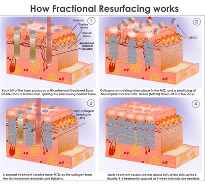 ADSS Co2 Fractional Laser System G900-S- Tratamento de Acne, Redução dos poros, Branqueamento da pele, Rejuvenescer a pele