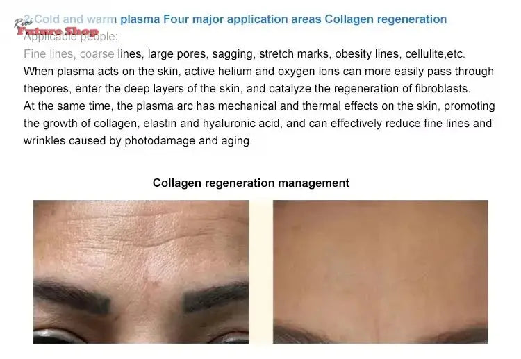 Newest 8 in 1Fusion Plasma Scalp Diamond Stamp Jet Plasma Professional Lase Fibroblast Ozone Wart Spray Pen Removal Salon - Rios Future Shop