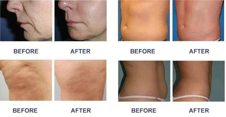 Equipment Skin Tightening Vacuum Slimming - Rios Future Shop